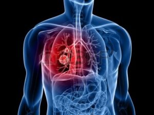 cancer-de-pulmon