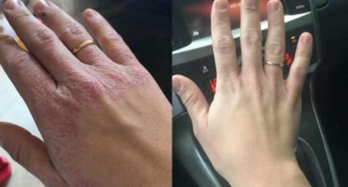 La mano de María antes y después de visitar Lourdes