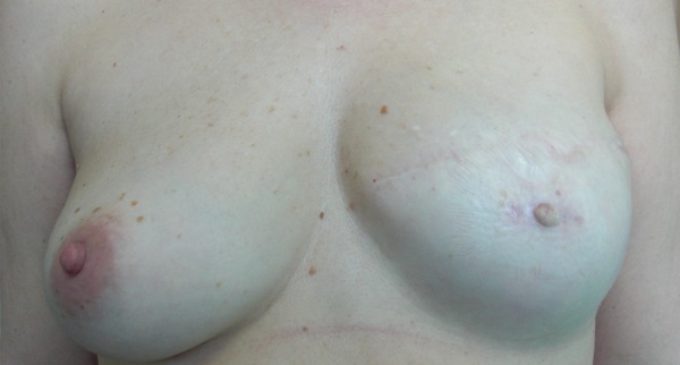 El Hospital Ramón y Cajal, líder en micropigmentación mamaria con más de 2.000 pacientes tratados